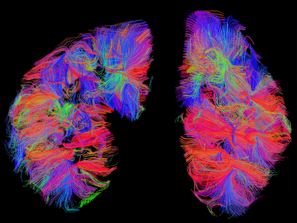 An MRI scan of diseased kidneys from Texas engineering assistant professor Adam Bush's research