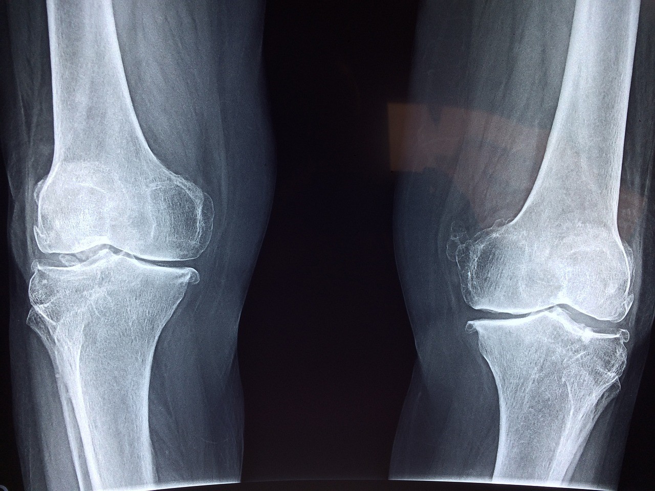 No Bones About It: New Details About Skeletal Cell Aging Revealed